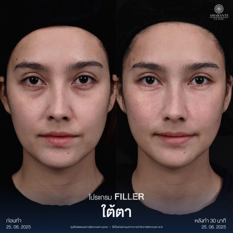 รีวิวฉีดฟิลเลอร์ใต้ตาที่ Amarante Clinic