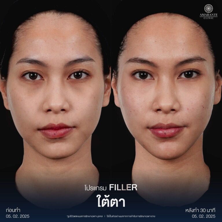 รีวิวฉีดฟิลเลอร์ใต้ตาที่ Amarante Clinic