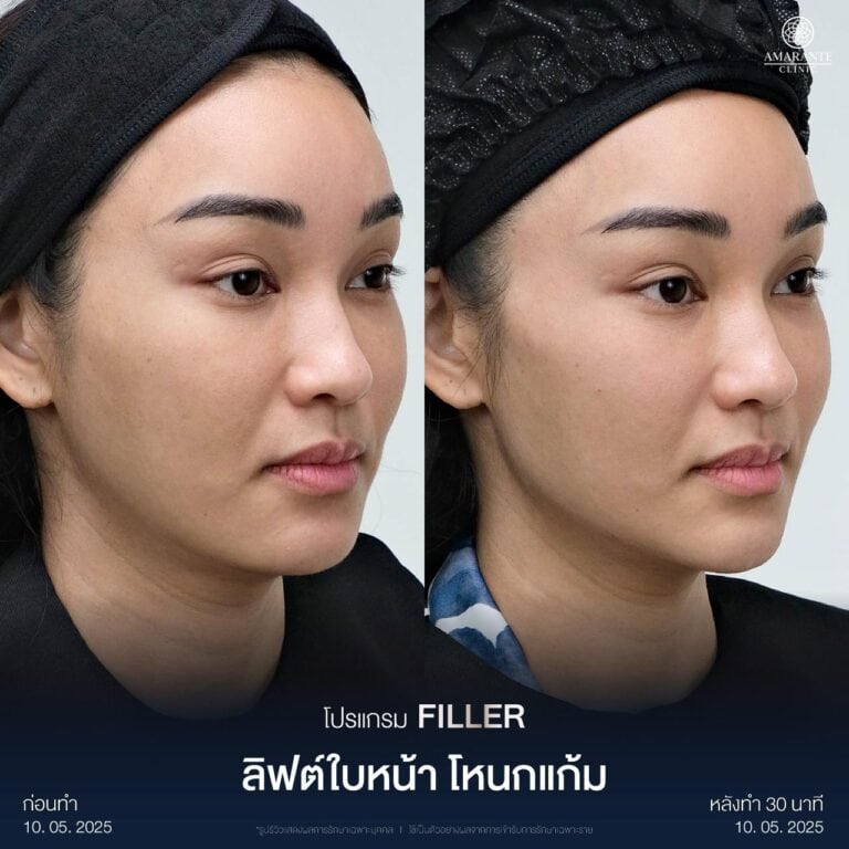 รีวิวฉีดฟิลเลอร์แก้ม