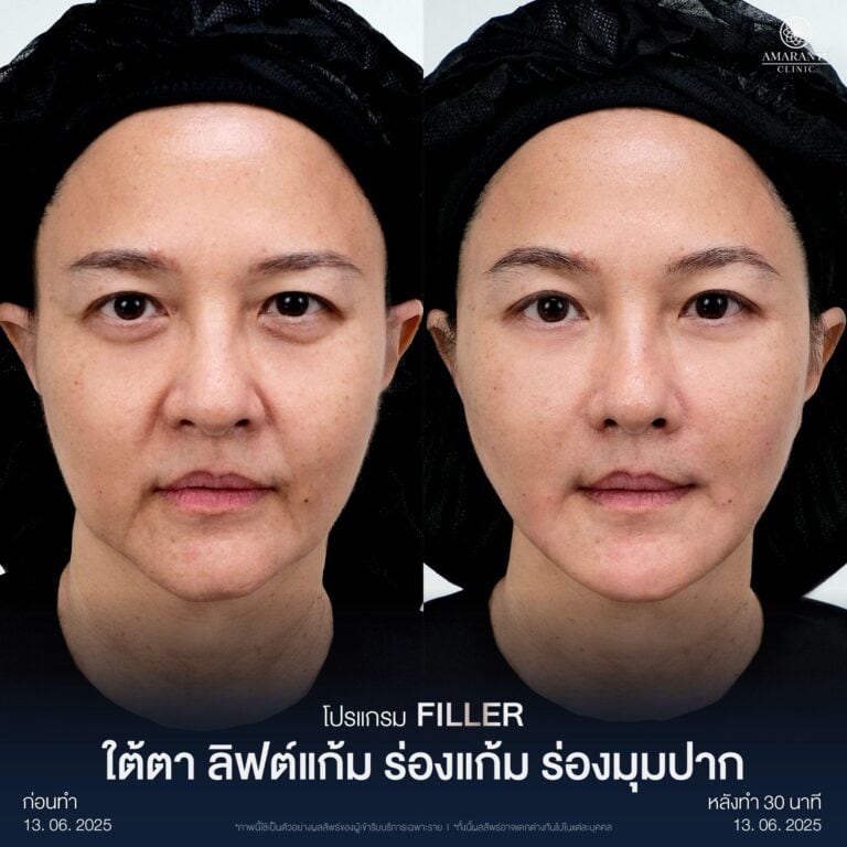รีวิวฉีดฟิลเลอร์ปรับรูปหน้า