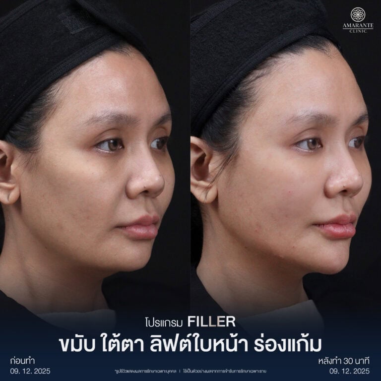 รีวิว Before - After ฉีดฟิลเลอร์แก้ม