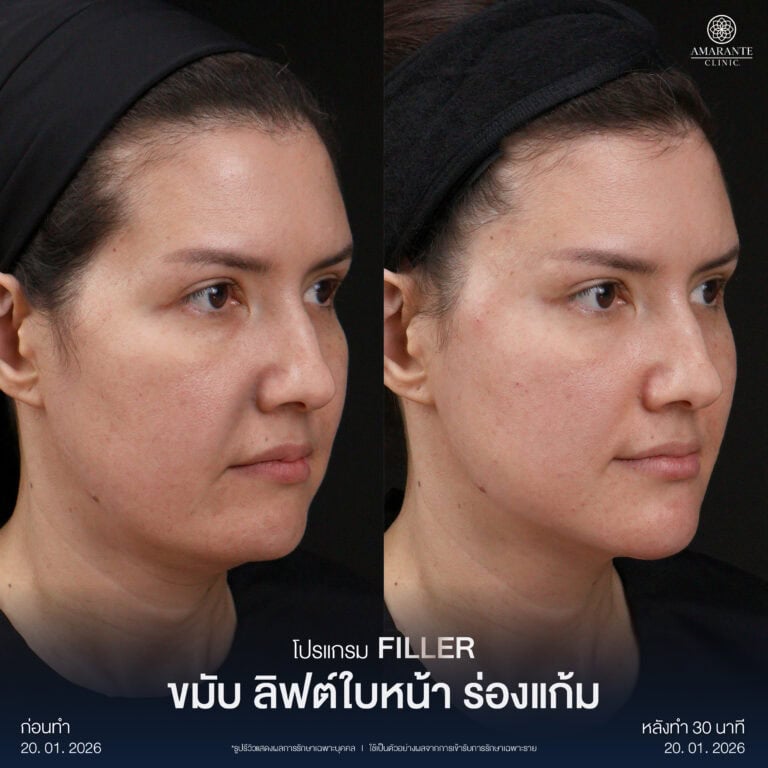 รีวิว Before - After ฉีดฟิลเลอร์แก้ม
