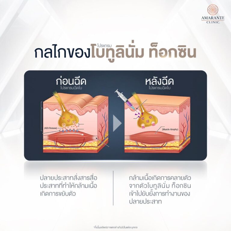 ฉีดโบท็อกช่วยอะไร