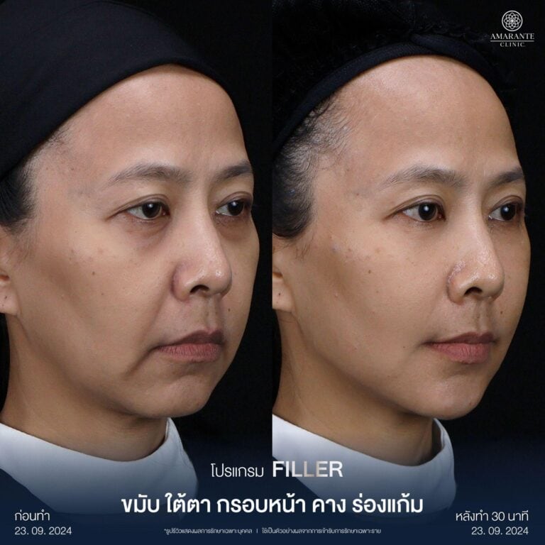 รีวิวฉีดฟิลเลอร์คาง
