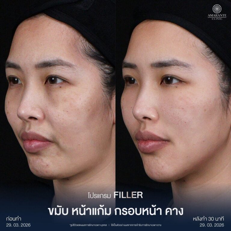 รีวิวฉีดฟิลเลอร์คาง