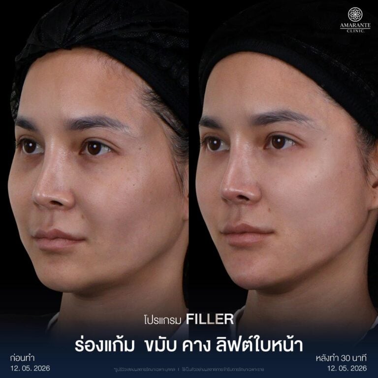 รีวิวฉีดฟิลเลอร์คาง