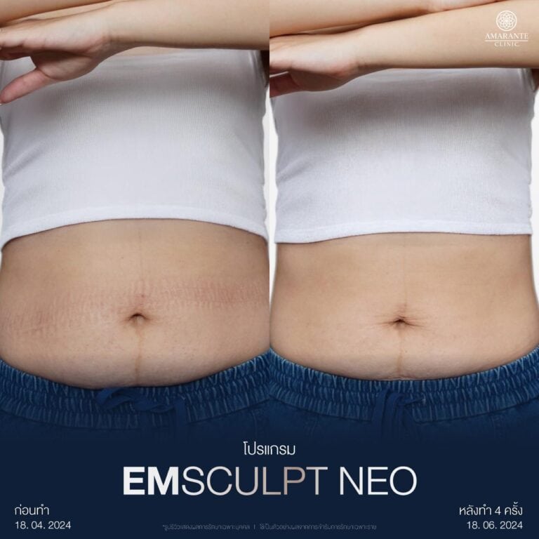 รีวิว Emsculpt ที่ Amarante Clinic