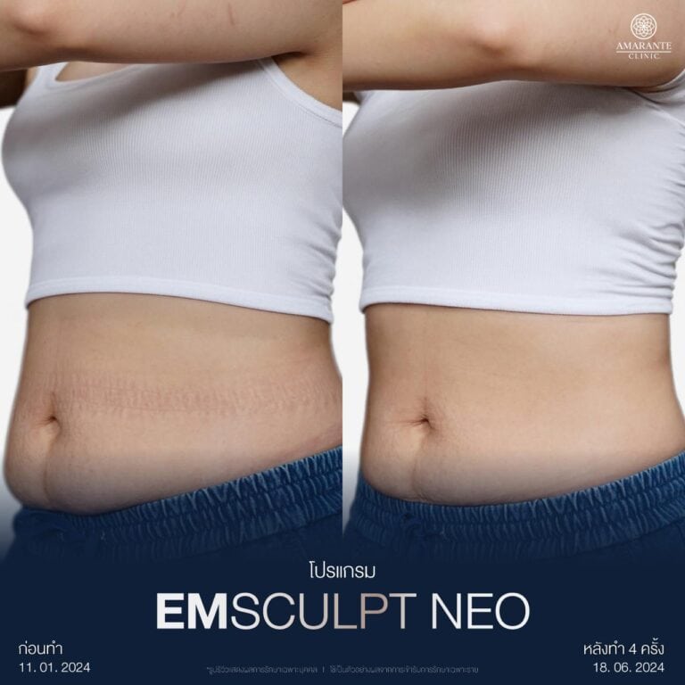 รีวิว Emsculpt ที่ Amarante Clinic