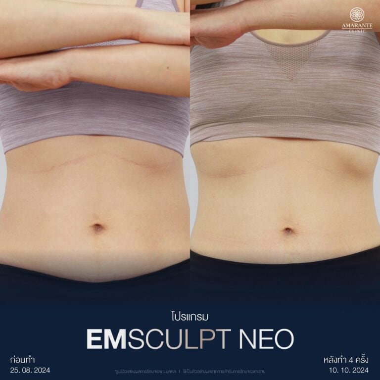 รีวิว Emsculpt ที่ Amarante Clinic