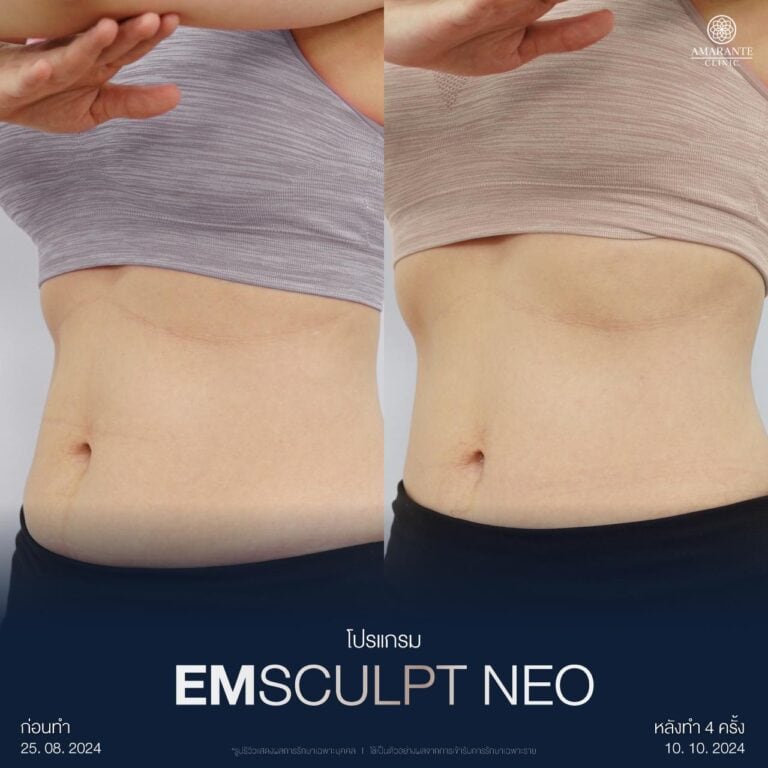 รีวิว Emsculpt ที่ Amarante Clinic