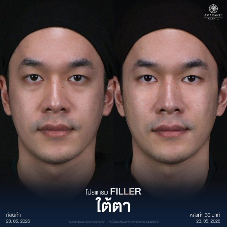 รีวิวฉีดฟิลเลอร์ใต้ตา