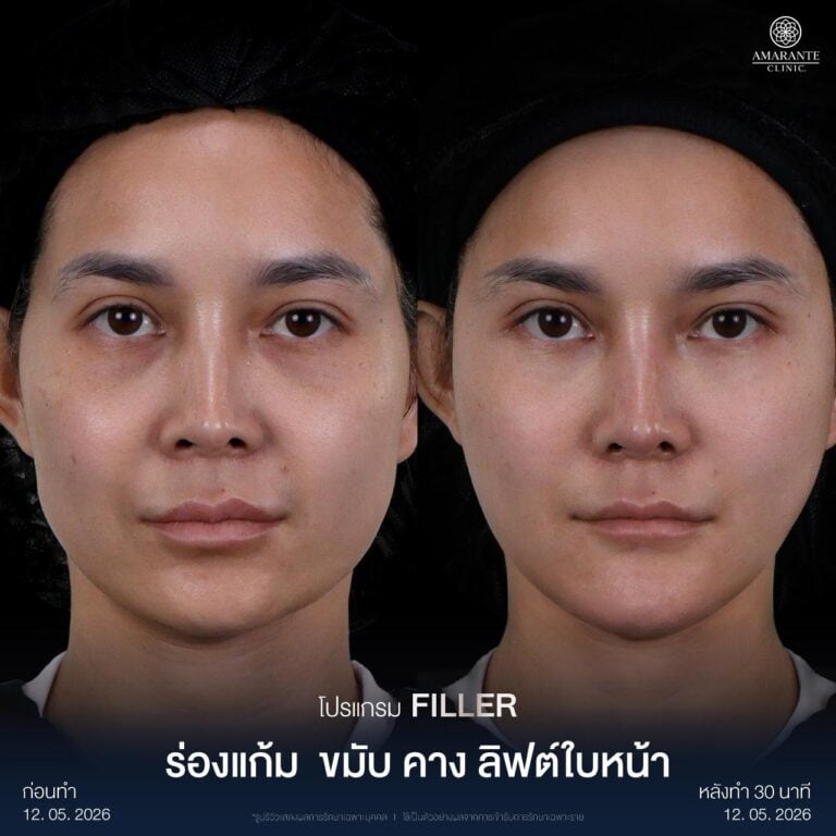 รีวิวฉีดฟิลเลอร์ ปรับรูปหน้า