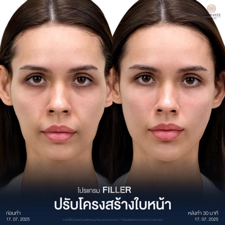 รีวิวปรับรูปหน้า ให้ได้สัดส่วนด้วยการยกกระชับหน้า โดยฉีดฟิลเลอร์