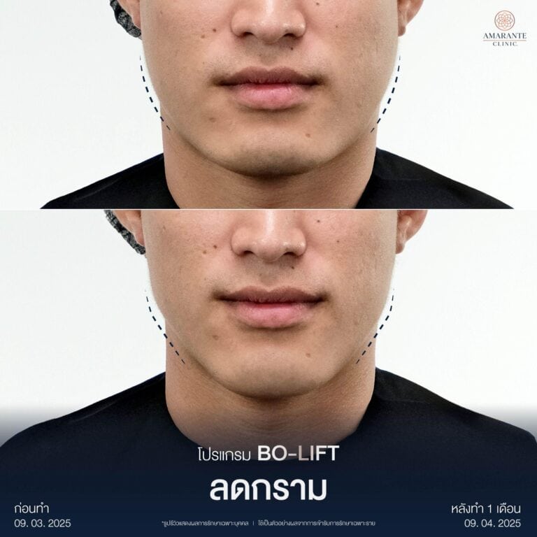 รีวิวปรับรูปหน้า ให้ได้สัดส่วนด้วยการยกกระชับหน้า โดยการฉ๊ดโบท็อก