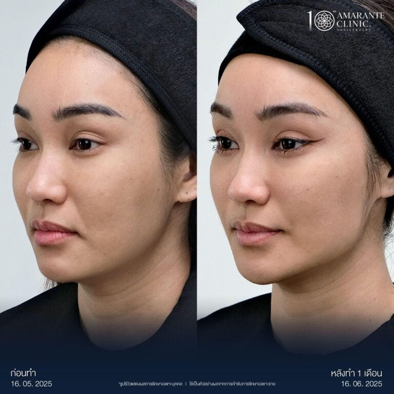 รีวิวปรับรูปหน้า ให้ได้สัดส่วนด้วยการยกกระชับหน้า โดยเครื่อง Ulthera Prime