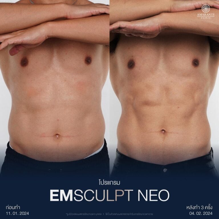 รีวิวผลลัพธ์ Emsculpt NEO