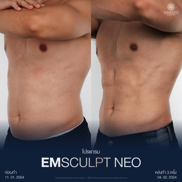 รีวิวผลลัพธ์สร้างซอกแพ็คด้วย Emsculpt NEO