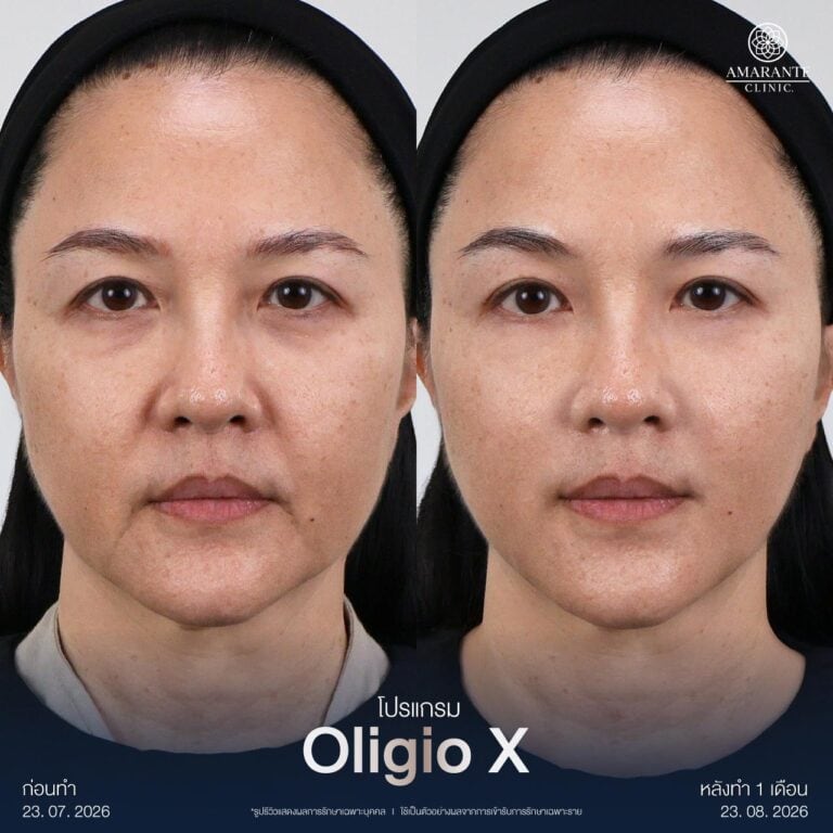 รีวิว Oligio X ปรับหน้าเบี้ยว ให้สมมาตร