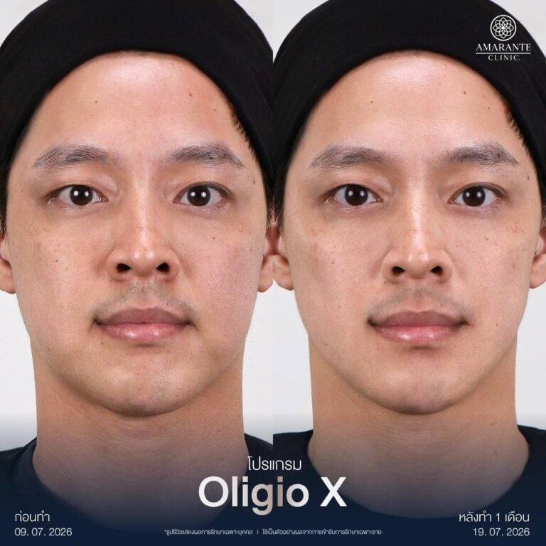 รีวิว Oligio X ปรับหน้าเรียว กรอบหน้าชัดขึ้น