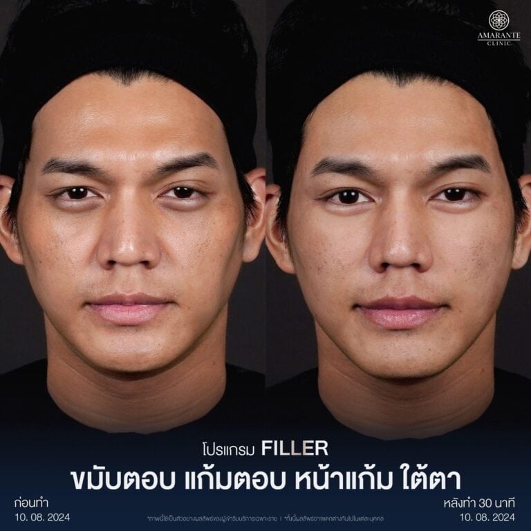 รีวิวฉีดฟิลเลอร์แก้มตอบ