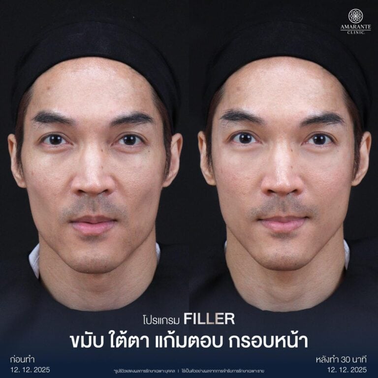 รีวิวฉีดฟิลเลอร์แก้มตอบ เติมแก้มตอบให้ลละมุน