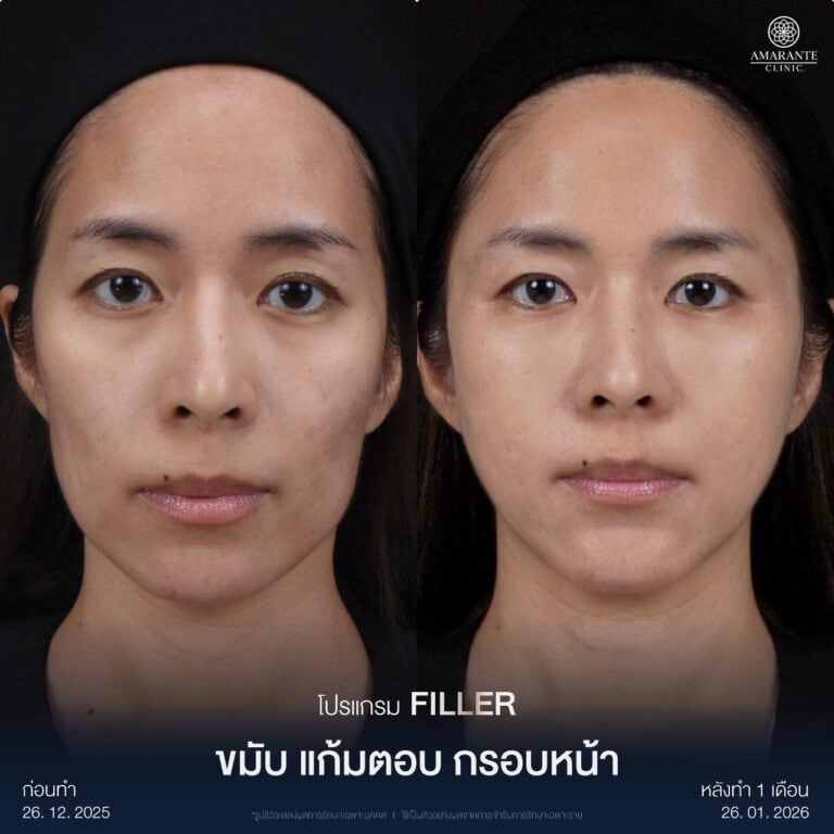 รีวิวฉีดฟิลเลอร์แก้มตอบ เติมแก้มยุบให้หายตอบ
