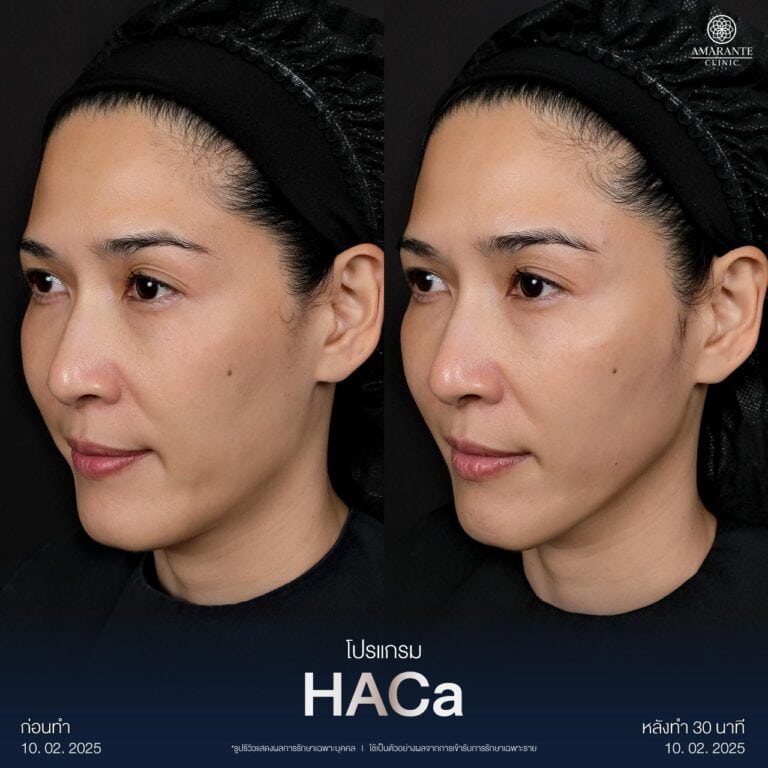 รีวิวฉีด HACa เติมแก้มตอบด้วย CaHA