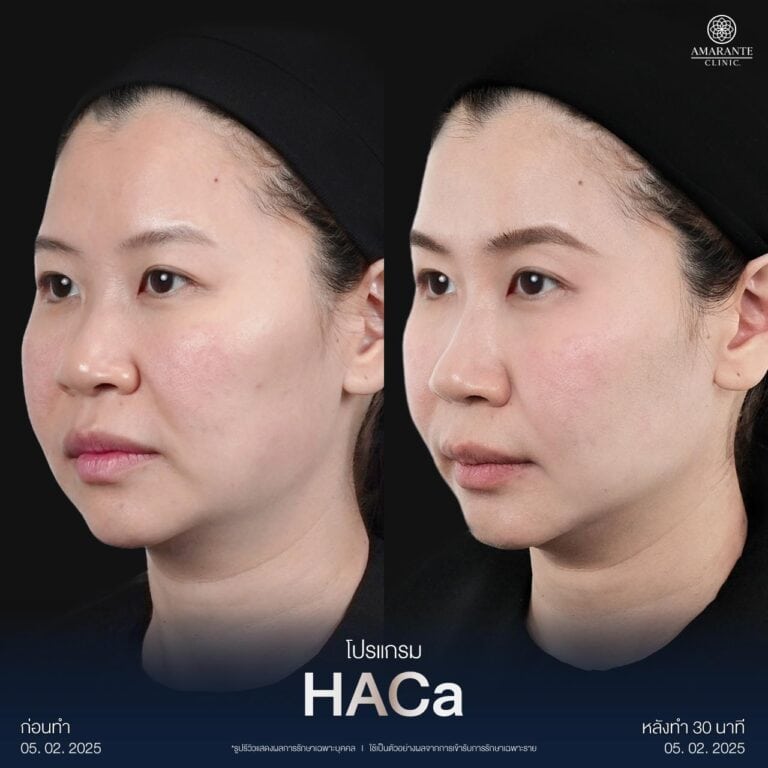 รีวิวฉีด CaHA เติมแก้มตอบด้วย HACa