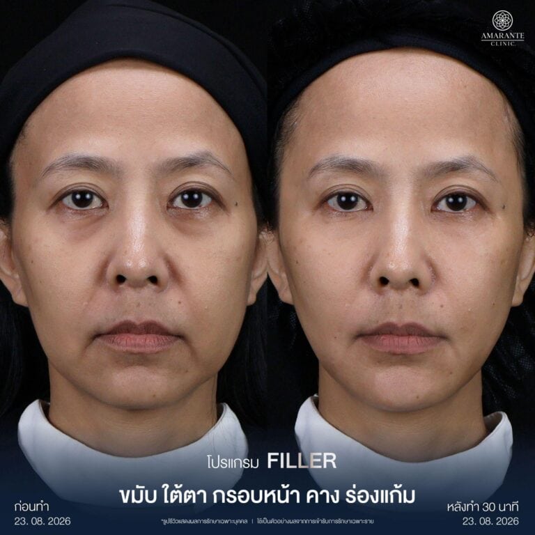 รีวิวฉีดฟิลเลอร์ โดยใช้เครื่องอัลตร้าซาวด์