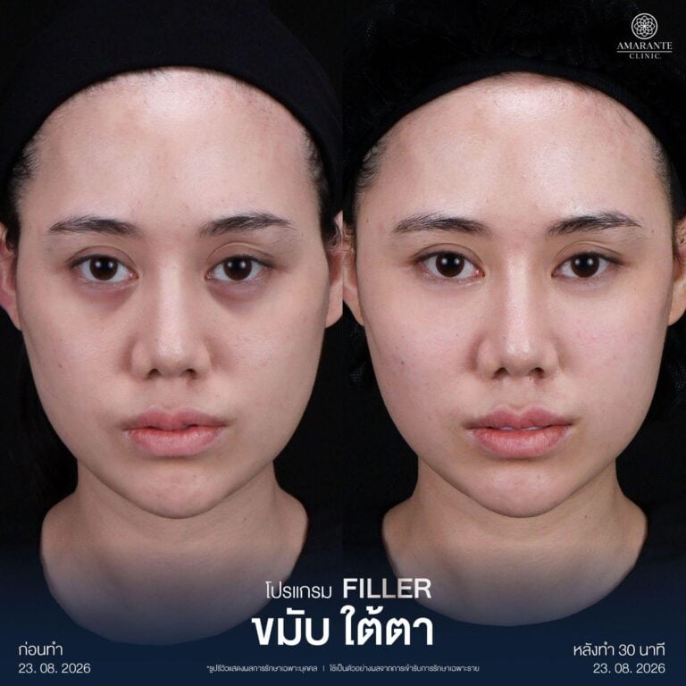 รีวิวฉีดฟิลเลอร์ โดยใช้เครื่อง Facial Ultrasound