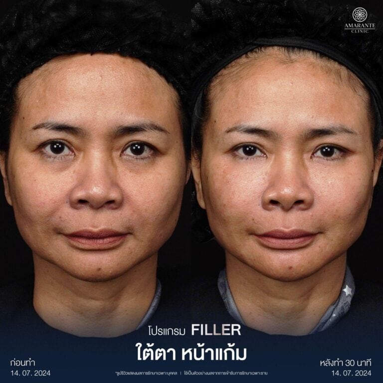 รีวิวฉีดฟิลเลอร์ โดยใช้เครื่องสแกนหน้า