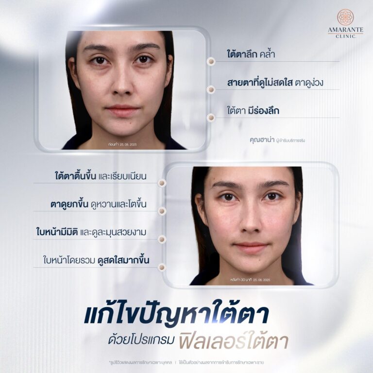 ฉีดฟิลเลอร์ใต้ตา ช่วยอะไรบ้าง