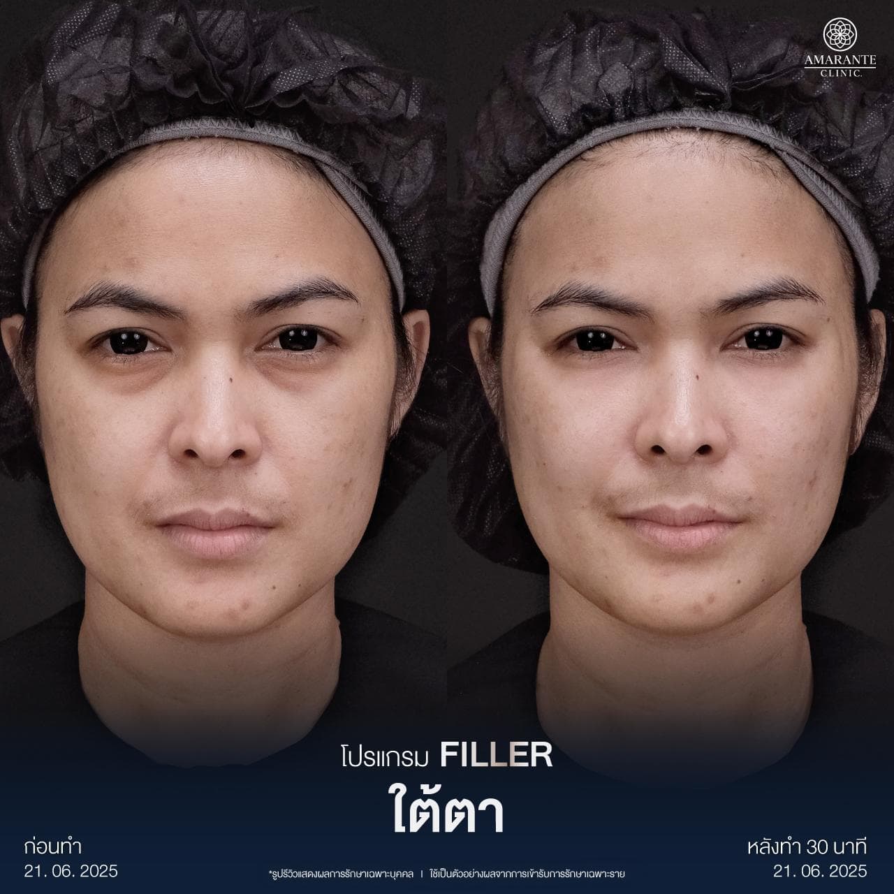 รีวิวฉีดฟิลเลอร์ใต้ตา