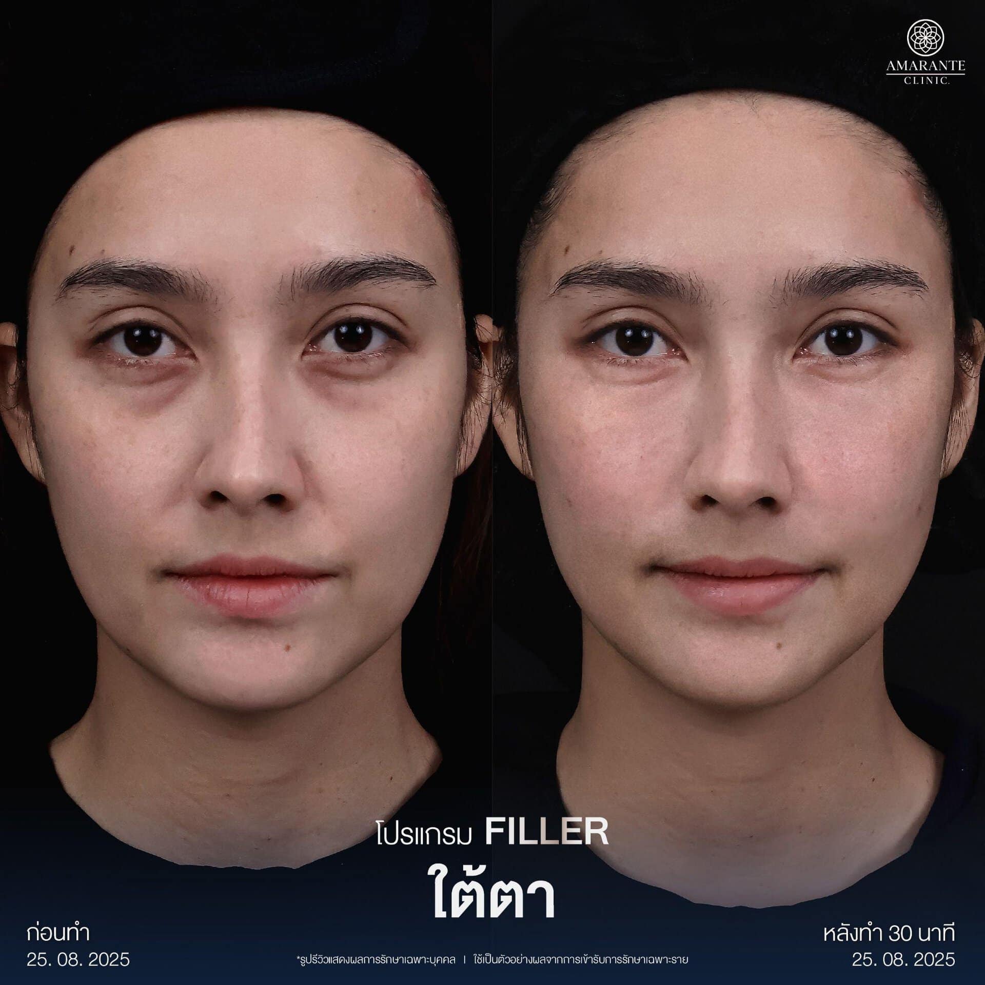 รีวิวฉีดฟิลเลอร์ใต้ตา