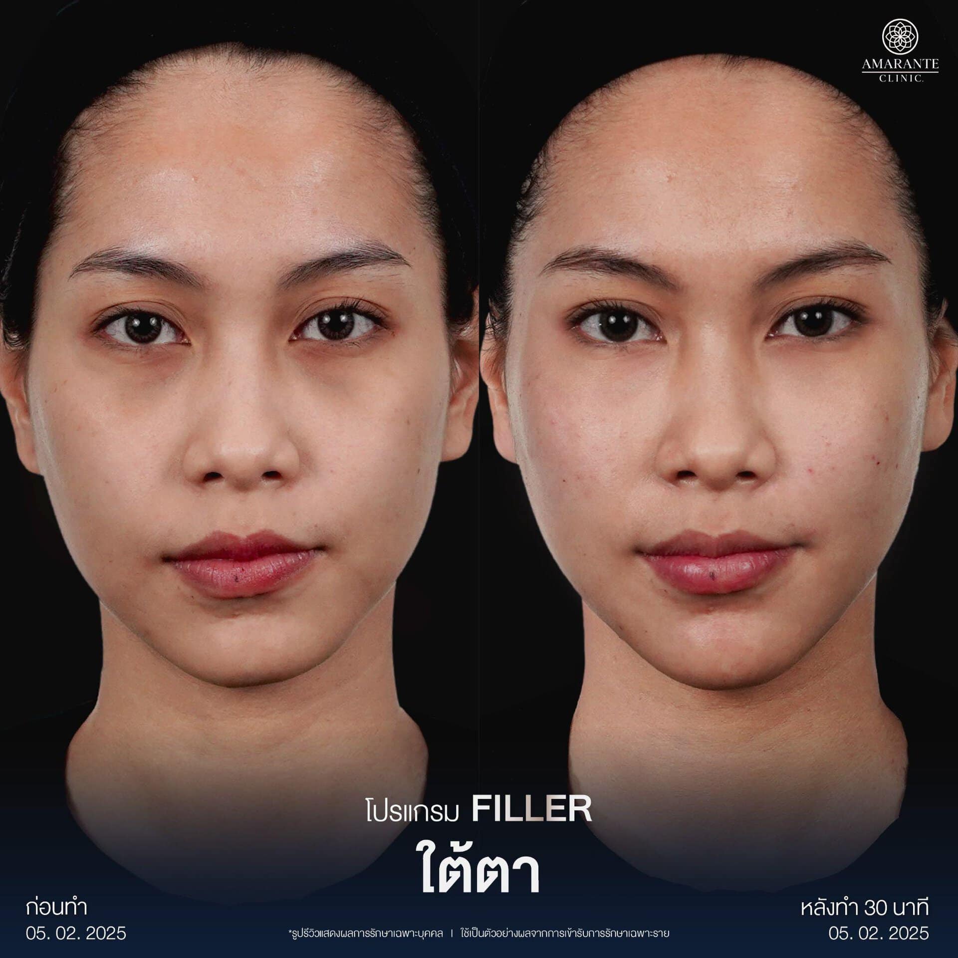 รีวิวฉีดฟิลเลอร์ใต้ตา