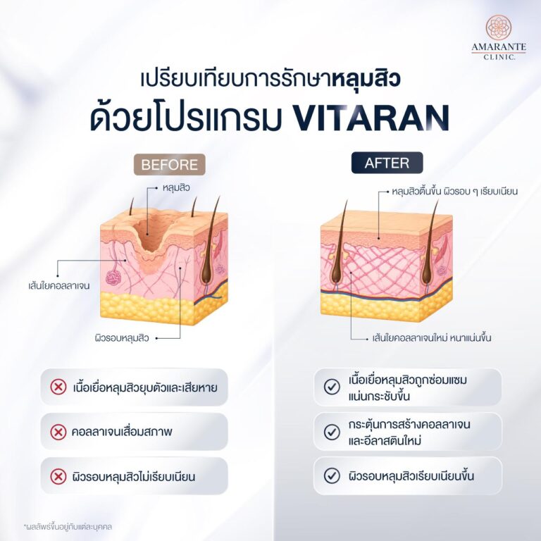 Vitaran ลดหลุมสิวได้อย่างไร