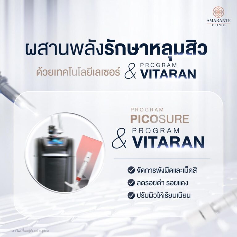เลเซอร์รักษาหลุมสิว ร่วมกับ Vitaran