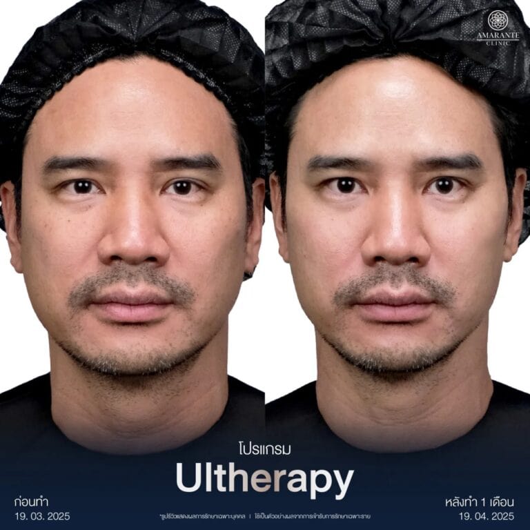 รีวิว Ulthera Prime น็อต วรฤทธิ์