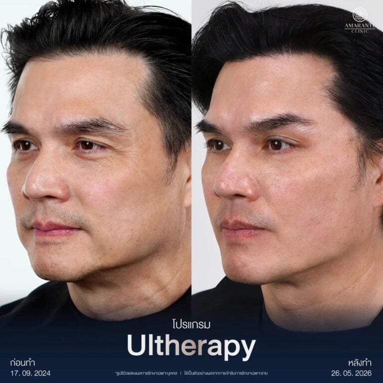 รีวิว Ulthera Prime แจ๊บ เพ็ญเพชร