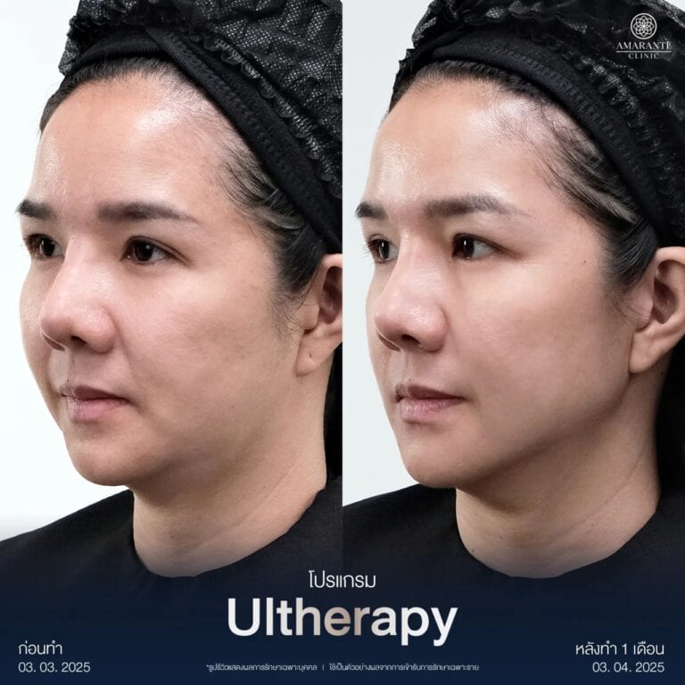 รีวิว Ulthera Prime เคสลูกค้าจริง