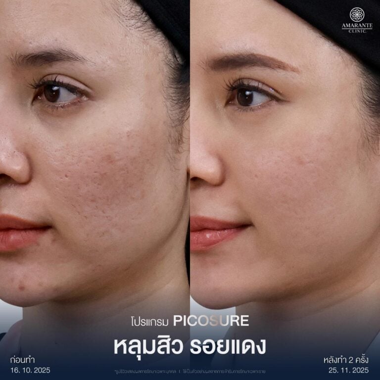 ลดรอยแดงจากสิว ด้วยเครื่อง Pico Laser