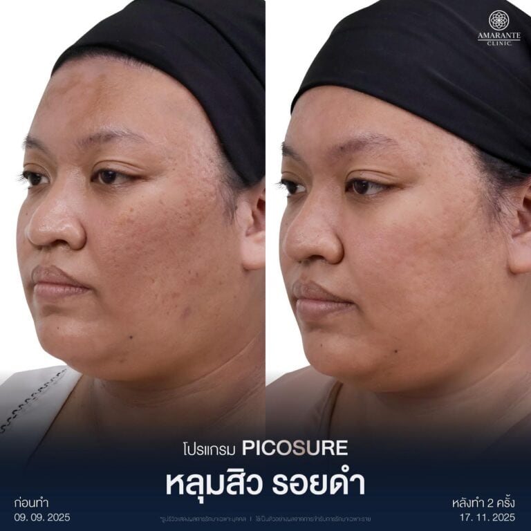 ลดรอยดำจากสิว ด้วยเครื่อง Pico Laser