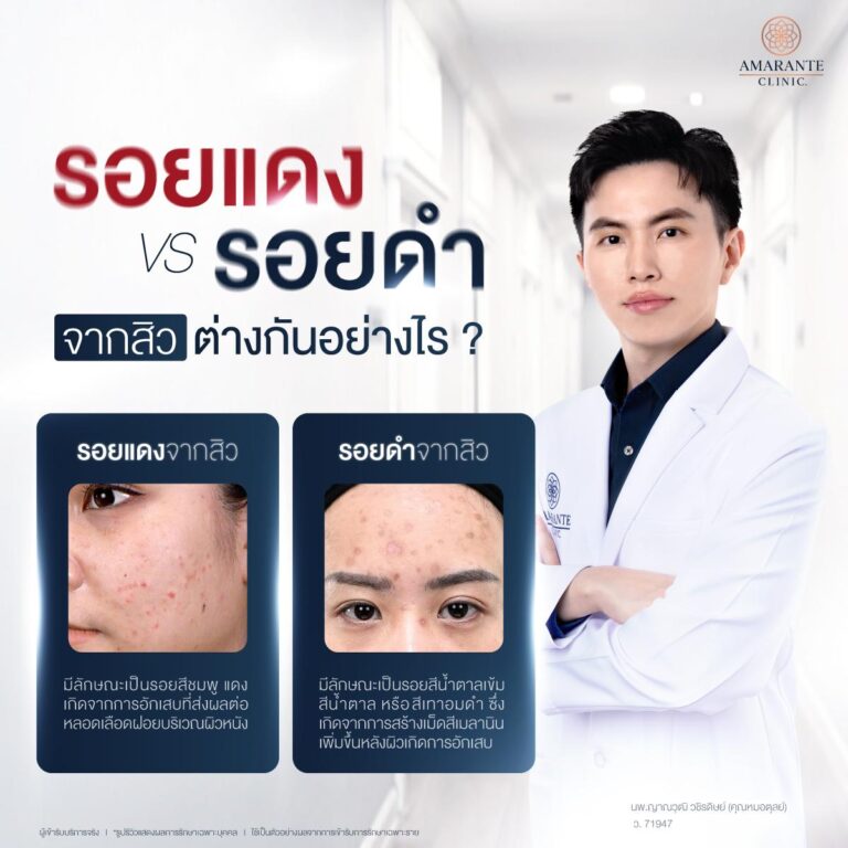 รอยแดง VS รอยดำ จากสิว ต่างกันอย่างไร