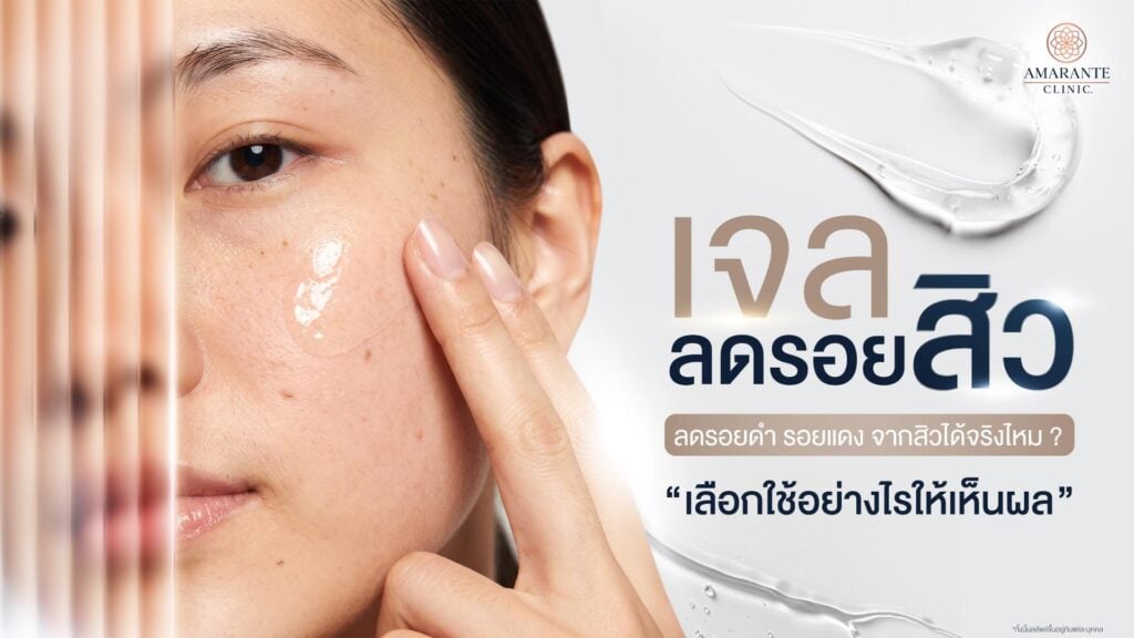 เจลลดรอยสิว คืออะไร ลดรอยดำ รอยแดงได้จริงไหม