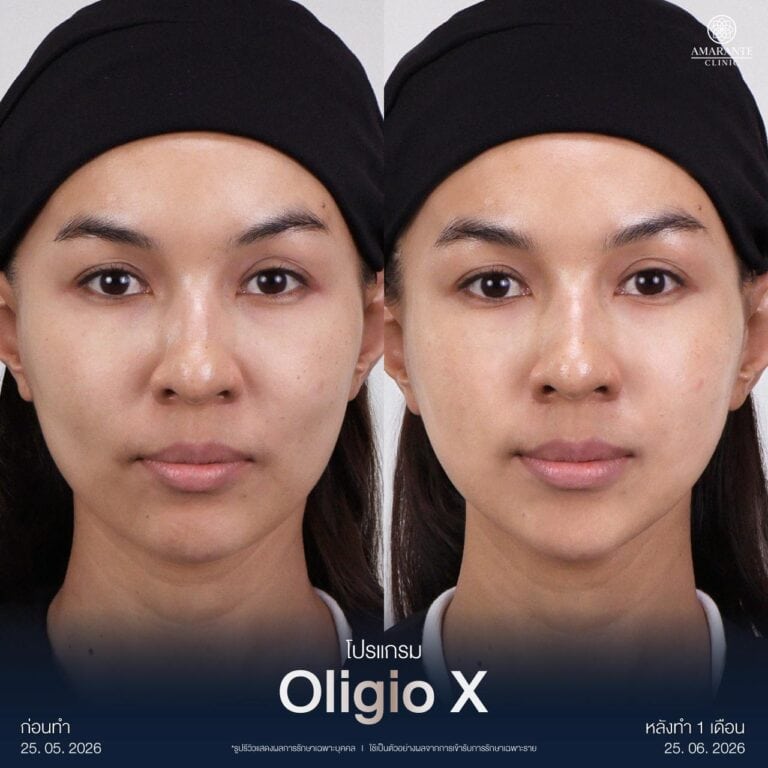 รีวิวกระตุ้นคอลลาเจนด้วย Oligio X