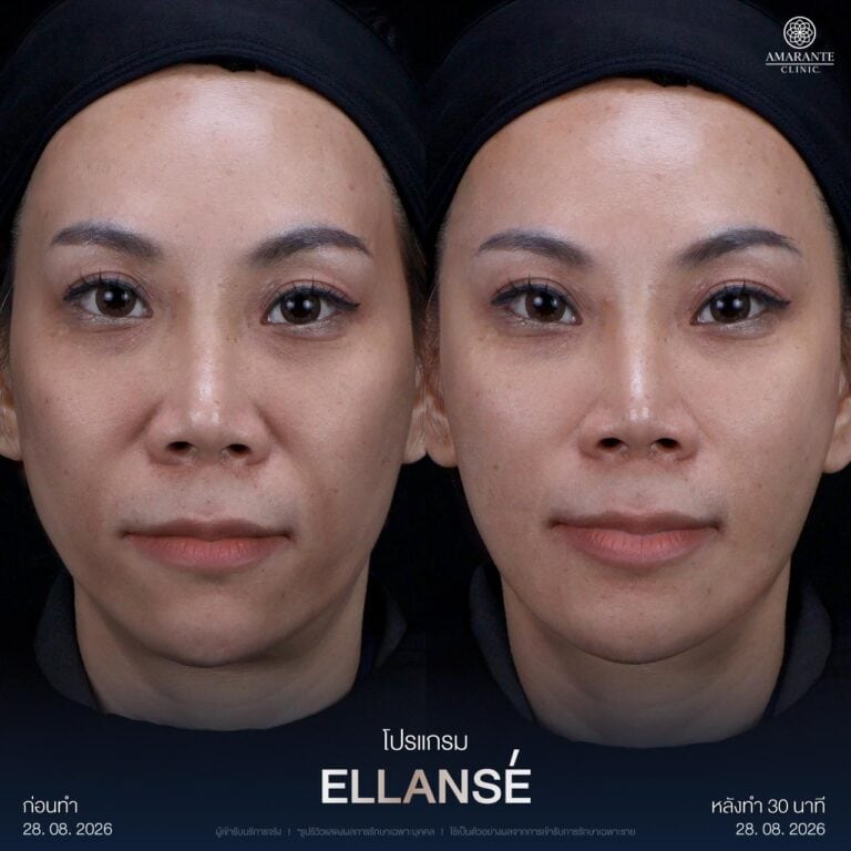 รีวิวกระตุ้นคอลลาเจนด้วย Ellanse