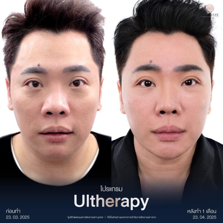 รีวิวกระตุ้นคอลลาเจนด้วย Ulthera Prime