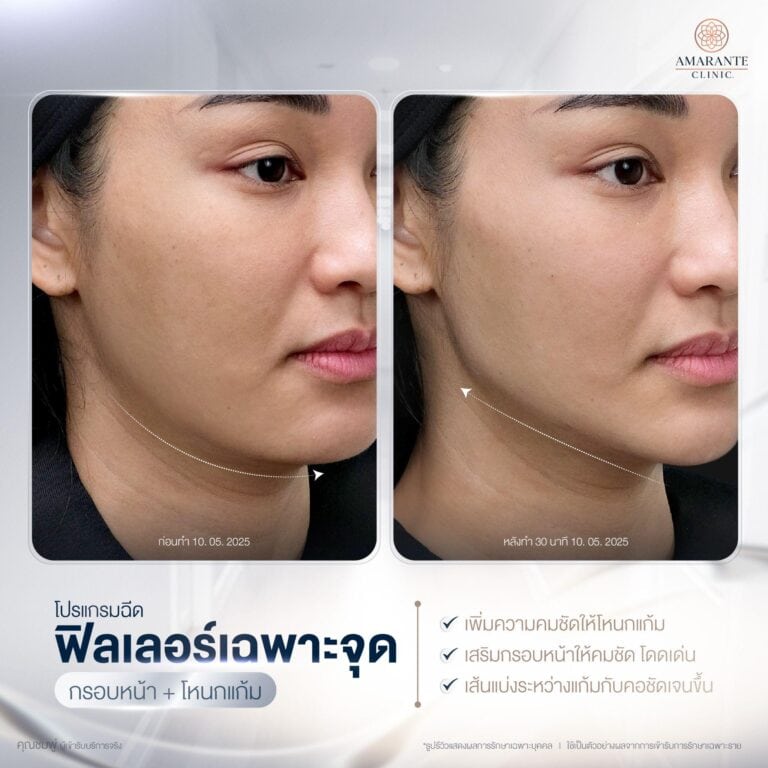ฉีดฟิลเลอร์ 2 CC ยกหน้าได้มากแค่ไหน?