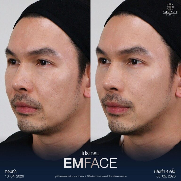 รีวิว Emface ปรับรูปหน้า