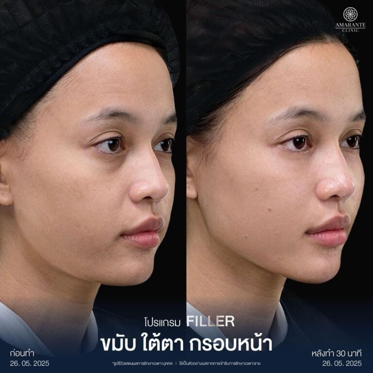 รีวิวฉีดฟิลเลอร์ปรับรูปหน้า